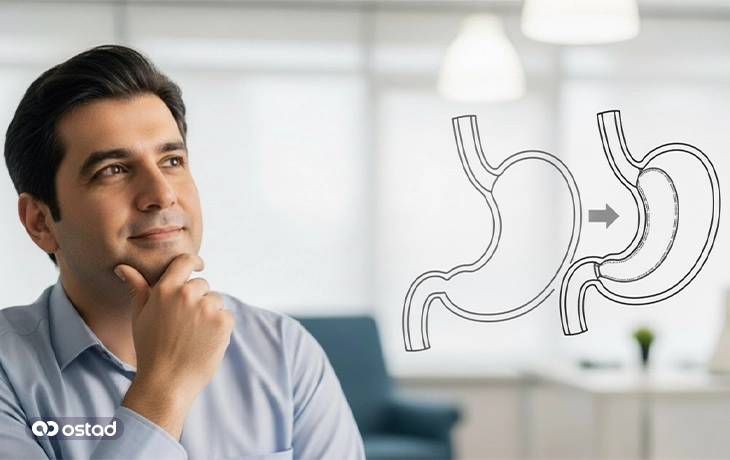 اسلیو معده چیست