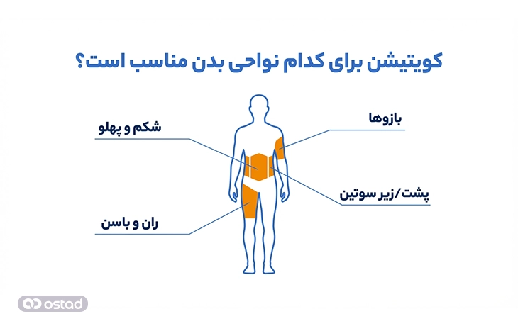 اینفوگرافی کویتیشن برای کدام نواحی بدن مناسب است؟